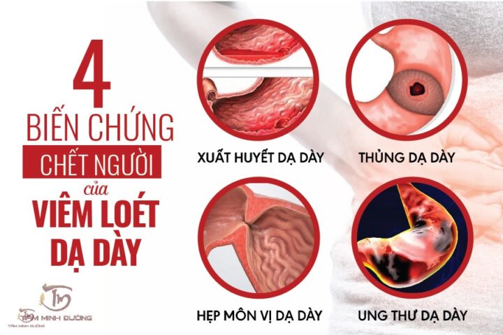 Viêm Loét Dạ Dày Tiếng Anh Là Gì? Toàn Diện Từ A Đến Z Viêm Loét Dạ Dày Tiếng Anh Là Gì? Toàn Diện Từ A Đến Z