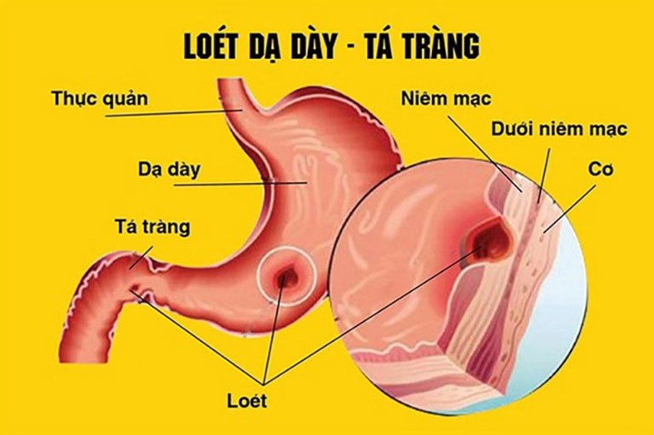 Viêm Loét Dạ Dày Tiếng Anh Là Gì? Toàn Diện Từ A Đến Z Viêm Loét Dạ Dày Tiếng Anh Là Gì? Toàn Diện Từ A Đến Z