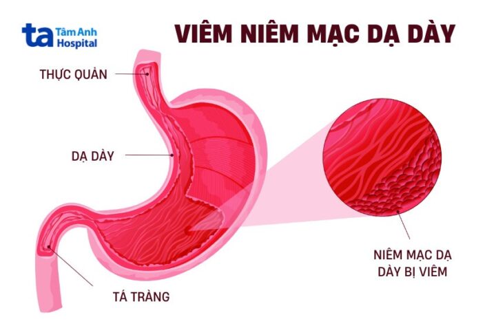 Viêm Niêm Mạc Dạ Dày Cấp Tính: Triệu Chứng, Nguyên Nhân Và Giải Pháp Điều Trị Hiệu Quả Viêm Niêm Mạc Dạ Dày Cấp Tính: Triệu Chứng, Nguyên Nhân Và Giải Pháp Điều Trị Hiệu Quả