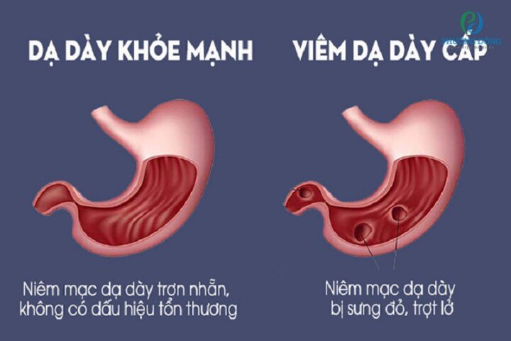 Viêm Niêm Mạc Dạ Dày Cấp Tính: Triệu Chứng, Nguyên Nhân Và Giải Pháp Điều Trị Hiệu Quả Viêm Niêm Mạc Dạ Dày Cấp Tính: Triệu Chứng, Nguyên Nhân Và Giải Pháp Điều Trị Hiệu Quả