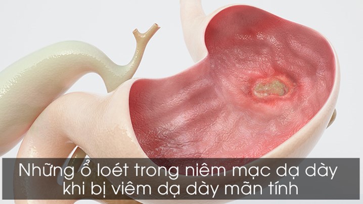 Viêm Niêm Mạc Dạ Dày Cấp Tính: Triệu Chứng, Nguyên Nhân Và Giải Pháp Điều Trị Hiệu Quả Viêm Niêm Mạc Dạ Dày Cấp Tính: Triệu Chứng, Nguyên Nhân Và Giải Pháp Điều Trị Hiệu Quả