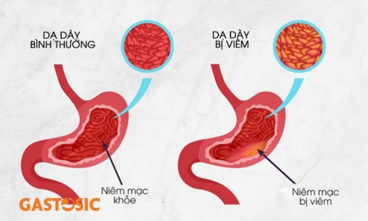Viêm Dạ Dày K29 6 Là Gì: Giải Mã Mã Bệnh, Triệu Chứng, Nguyên Nhân Và Điều Trị Hiệu Quả Viêm Dạ Dày K29 6 Là Gì: Giải Mã Mã Bệnh, Triệu Chứng, Nguyên Nhân Và Điều Trị Hiệu Quả