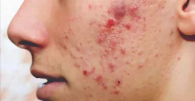 Hình ảnh mụn viêm sưng tấy, đau nhức, minh họa cách giảm mụn viêm nhanh nhất